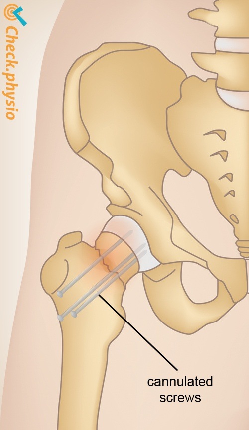 Hüfte Hüftfraktur Schraubenfixation