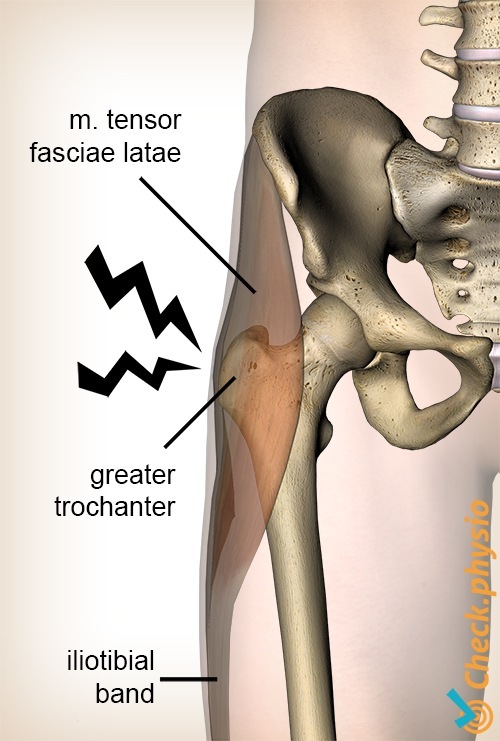 Hüft Trochanter major Schmerzsyndrom Anatomie Tensor fasciae latae Tractus iliotibialis