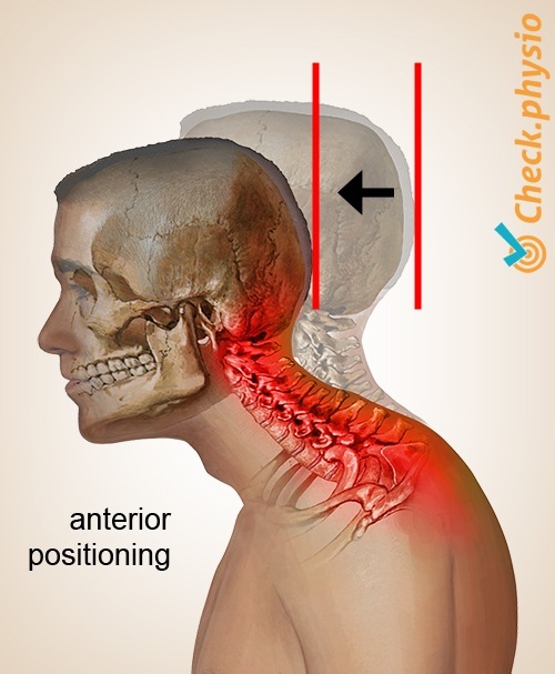 Kopf Hals zervikales Haltungssyndrom anteriore Position