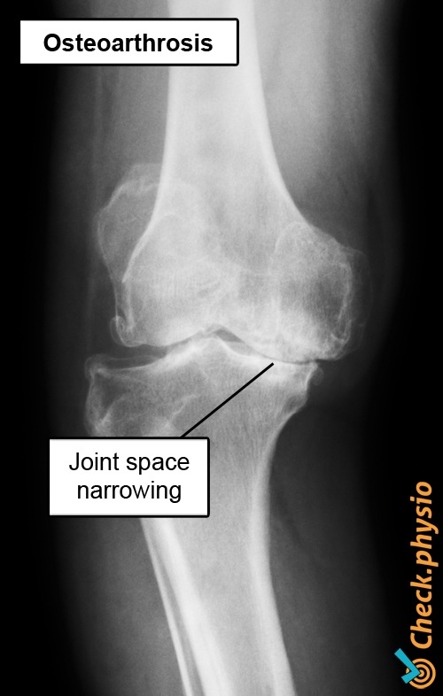 Knie Arthrose Röntgen