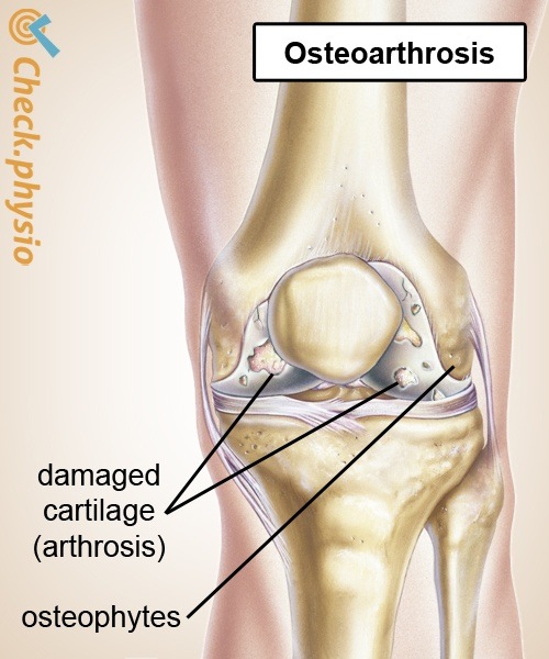 Knie Arthrose Abnutzung Knorpel