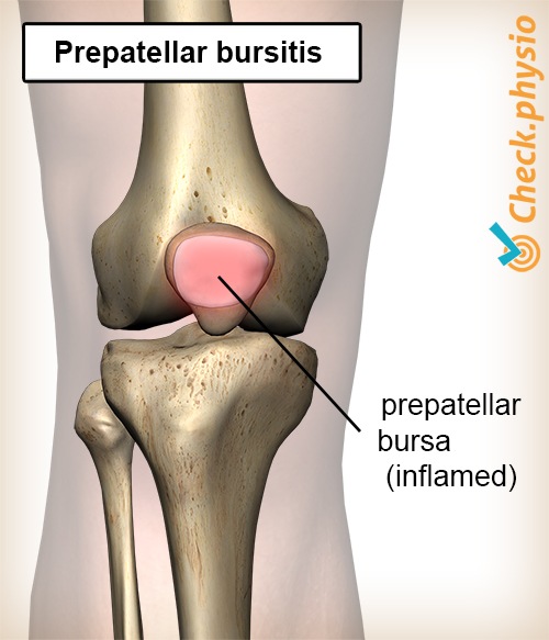 Knie Schleimbeutelentzündung Prepatellaris Bursitis entzündeter Schleimbeutel Kniescheibe