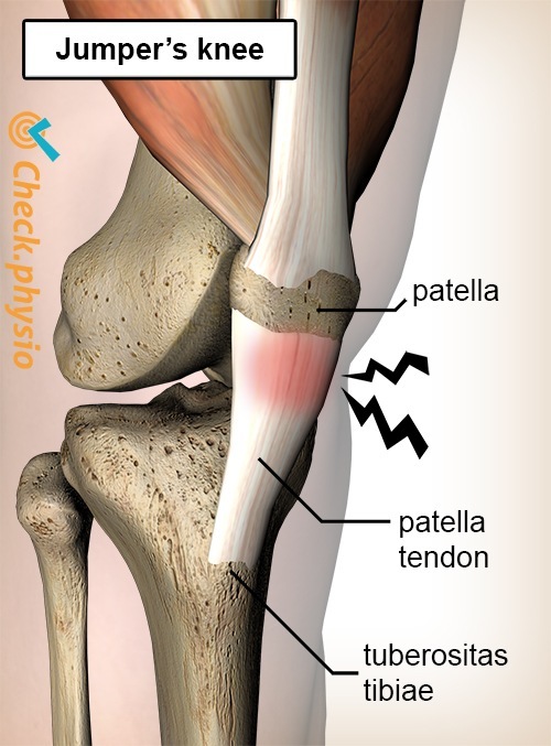 Knie Jumpers Knee Schmerz Patellasehne Tendinitis