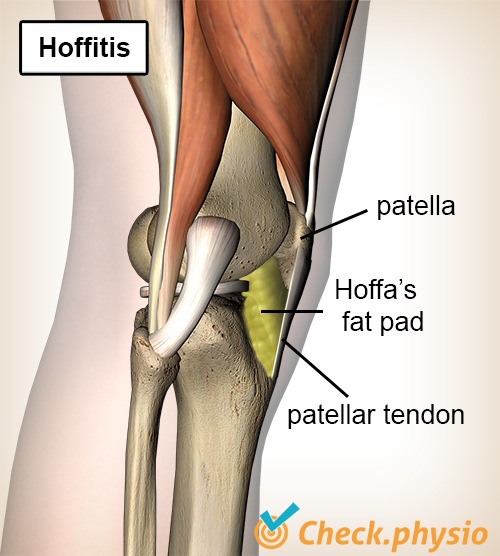 Knie Hoffa Körper Hoffitis Fettkörper