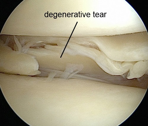 Knie Meniskus Degeneration degenerativ