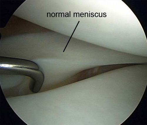 Knie Meniskus Degeneration gesund