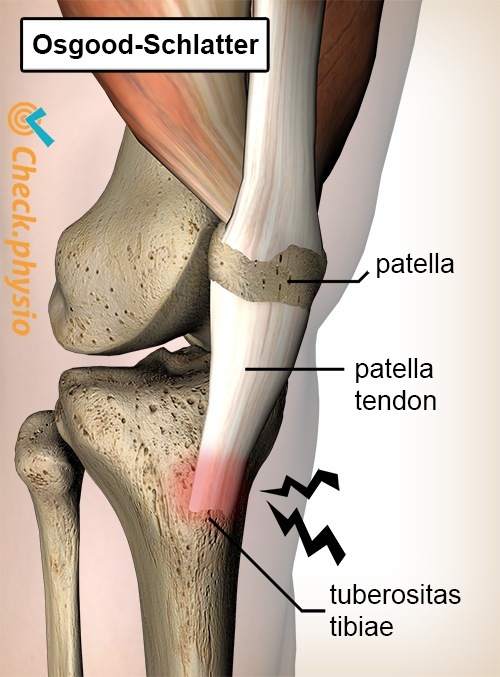 Knie Osgood Schlatter Schmerz Patellasehne