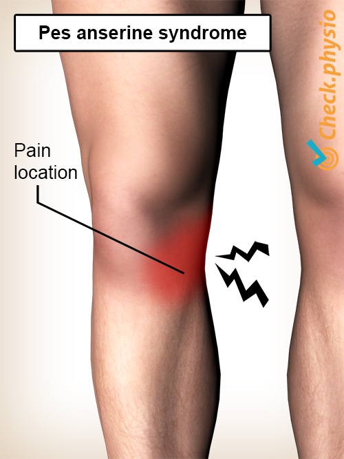 Knie Pes Anserinus Syndrom Schmerzlokalisation