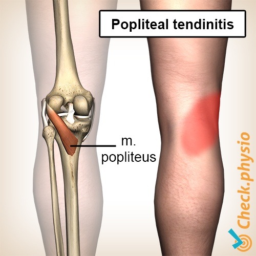 Knie Popliteus Tendinitis