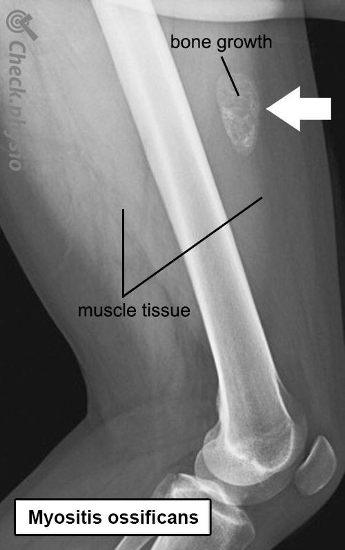 Myositis ossificans Röntgenbild Anatomie