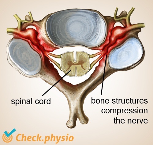 Nacken zervikale Radikulopathie Stenose harter Nackenbruch