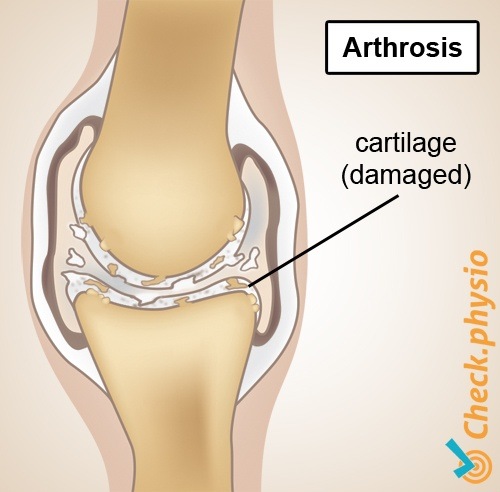 Arthrose Anatomie Abgenutzt