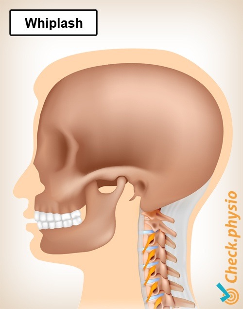 Nacken Whiplash Schmerz