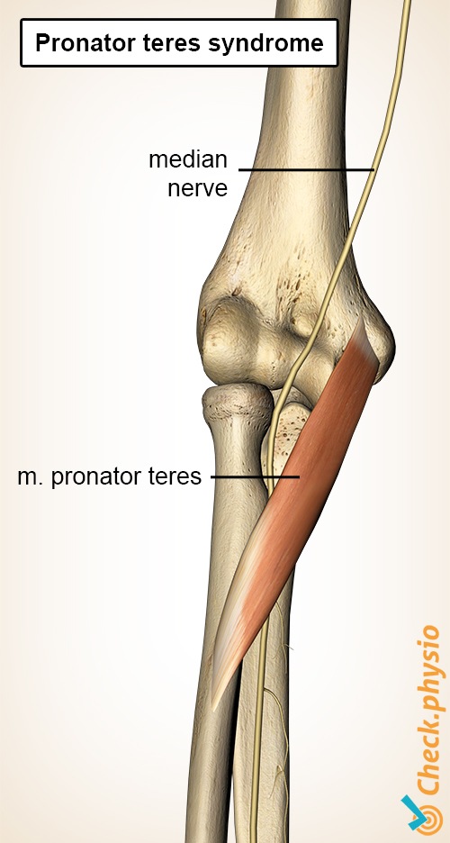 Unterarm Pronator-Teres-Muskel Medianusnerv Syndrom