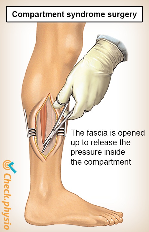 unteres Bein Kompartmentsyndrom Operation