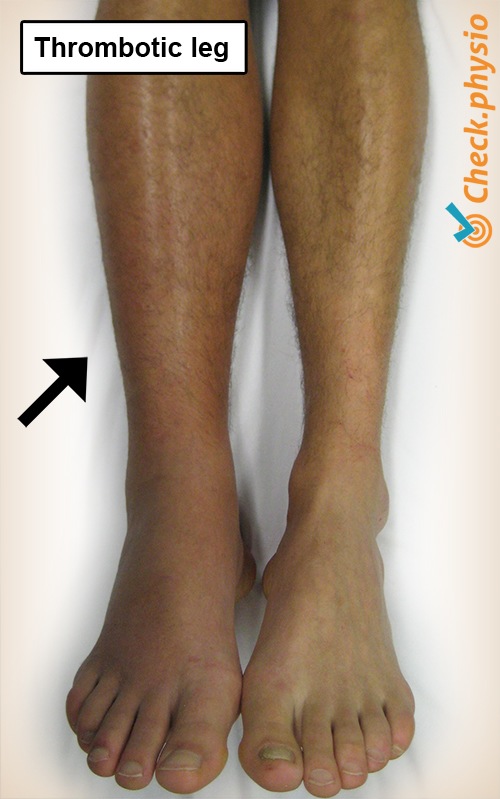 Unterschenkel Thrombosebein Thrombose Schwellung