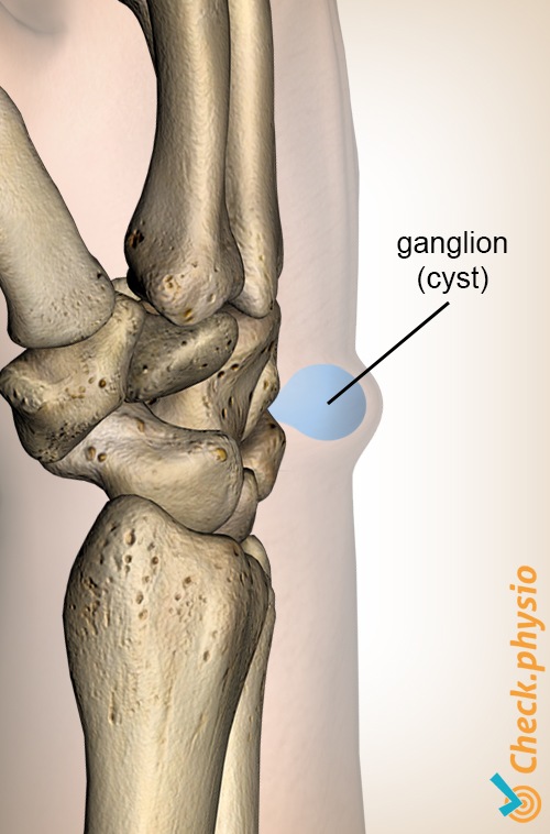 Handgelenk Ganglion Zyste Anatomie