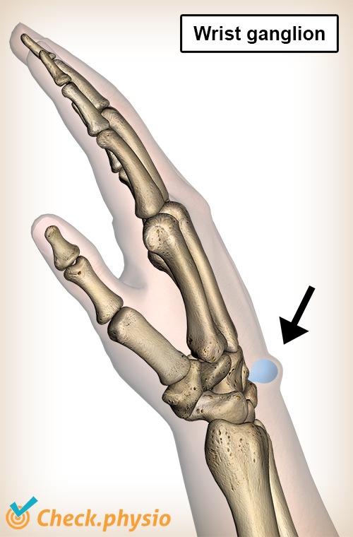 Handgelenk Ganglion Schwellung Beule Anatomie Schleimzyste Mucoidzyste