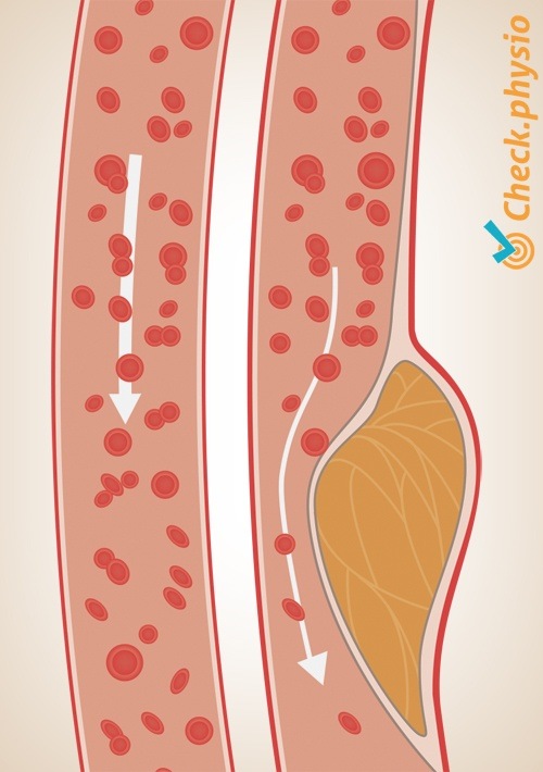 Arteriosklerose Arterie