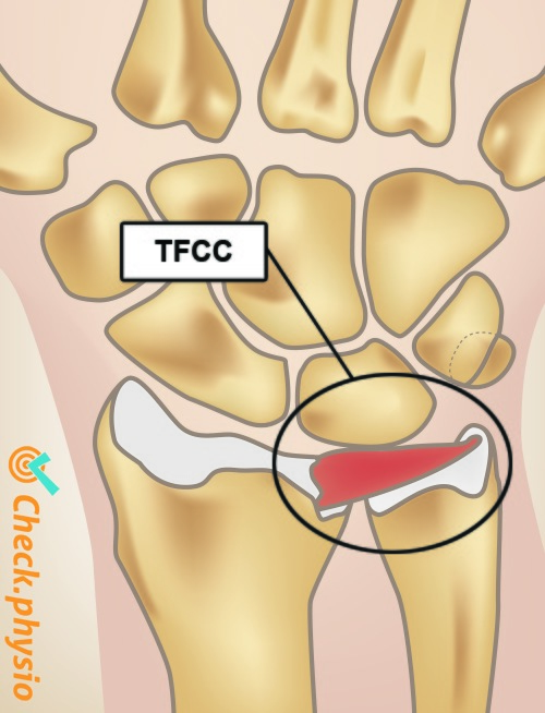 Handgelenk TFCC