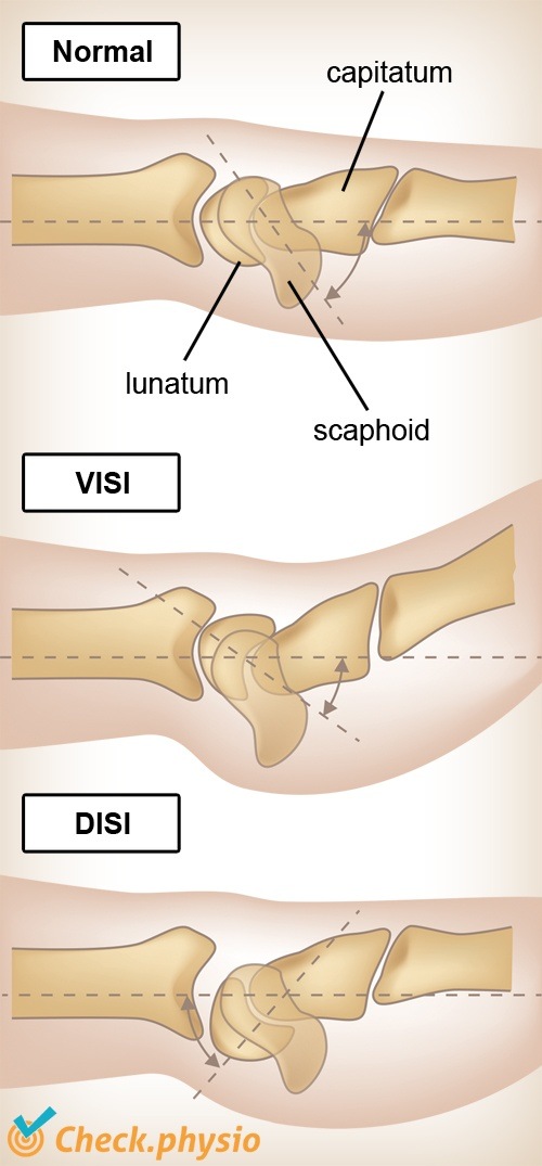 Handgelenk VISI DISI