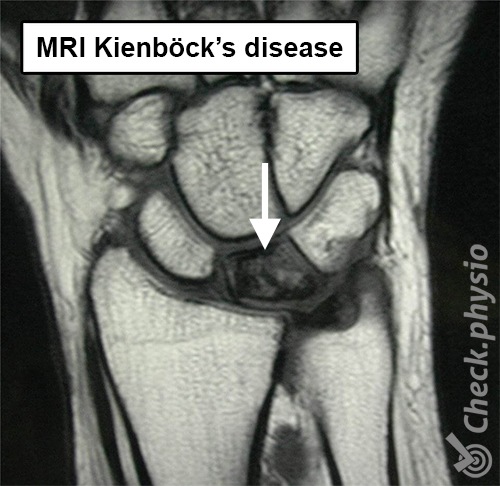 Handgelenk Kienböck-Krankheit MRI Os lunatum