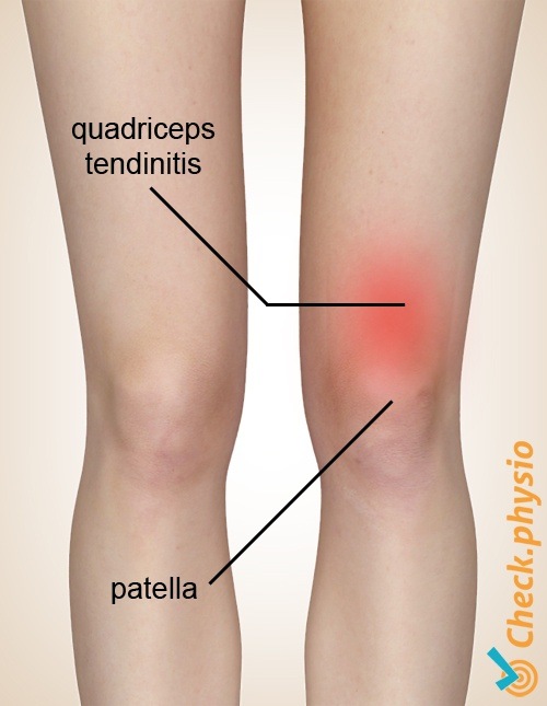 Quadrizeps Tendinitis