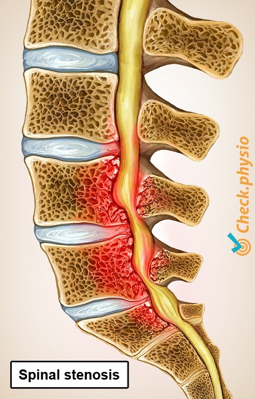 Rücken Spinalkanalstenose Verengung Wirbelkanal Anatomie Querschnitt