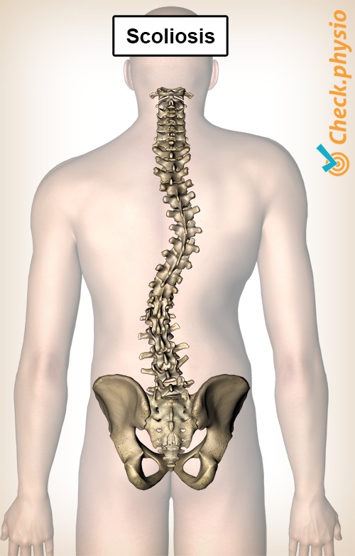 Rücken Skoliose Krümmung Wirbelsäule