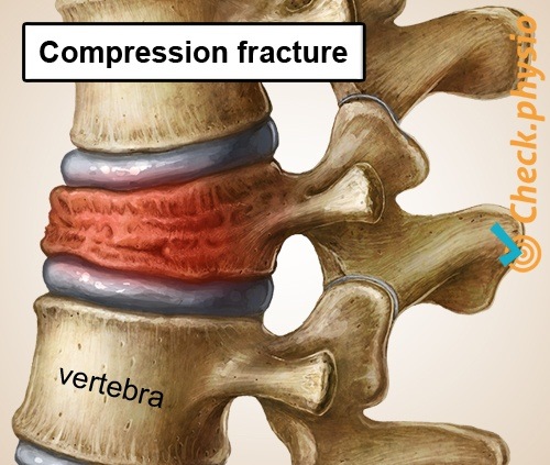 rückenspezifische tiefe Rückenschmerzen eingestürzter Wirbel