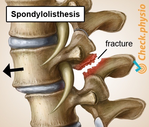 rückenspezifische tiefe Rückenschmerzen Spondylolisthesis verschobener Wirbel