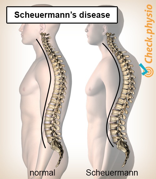 Rücken Scheuermannsche Krankheit Haltung Wirbelsäule Wölbung Kyphose