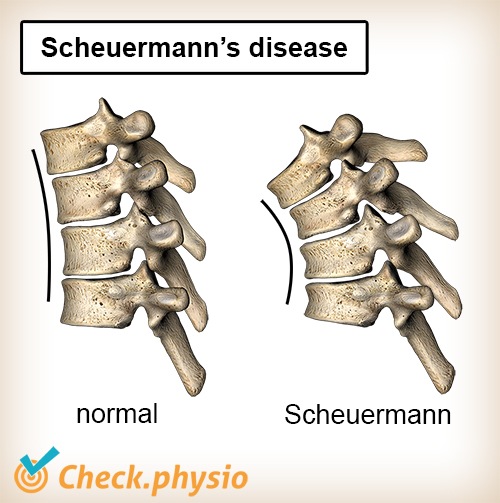 Rücken Scheuermannsche Krankheit Wirbelsäule normal Wölbung Kyphose Anatomie keilförmig