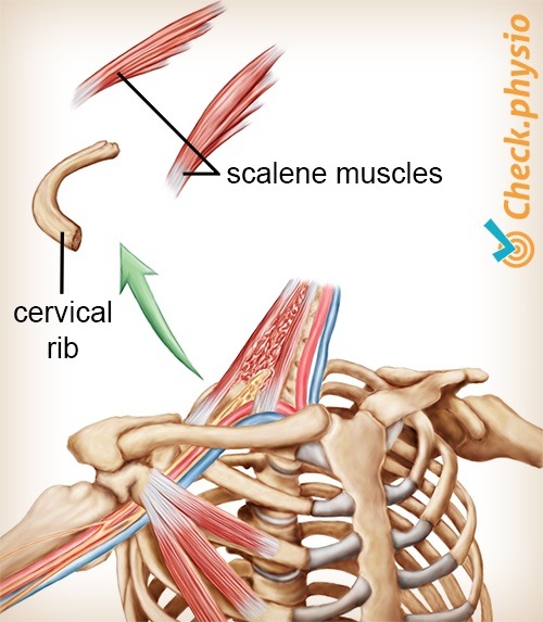 Schulter Arm Hand TOS Thoracic-Outlet-Syndrom Halsrippe