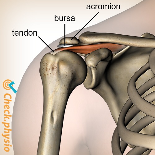 Schulter Impingement Schleimbeutel Bursa Supraspinatus