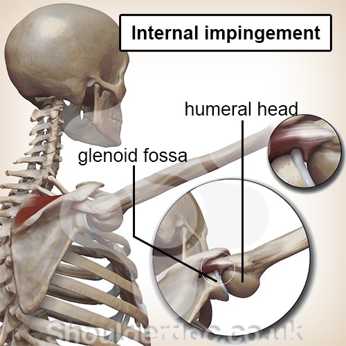 Schulter internes Impingement Schulterkopf Schultergelenk Einklemmen