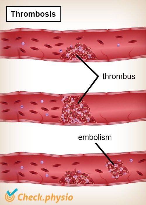 Thrombose Thrombus Embolie Blutgefäß Vene Arterie