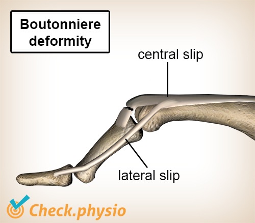 Finger Knopflochdeformität Strecksehne Seitenschlupf Zentraler Schlupf