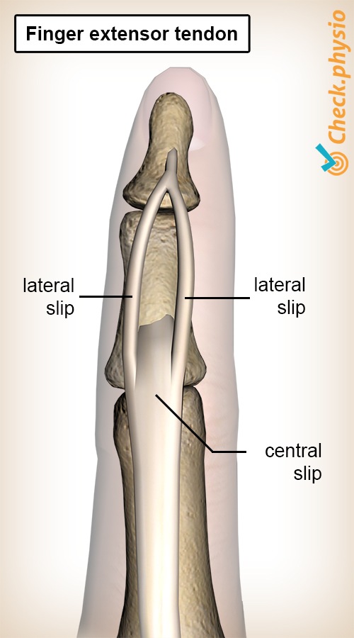 Finger Strecksehne Schlupfen Zentraler Seitenschlupf