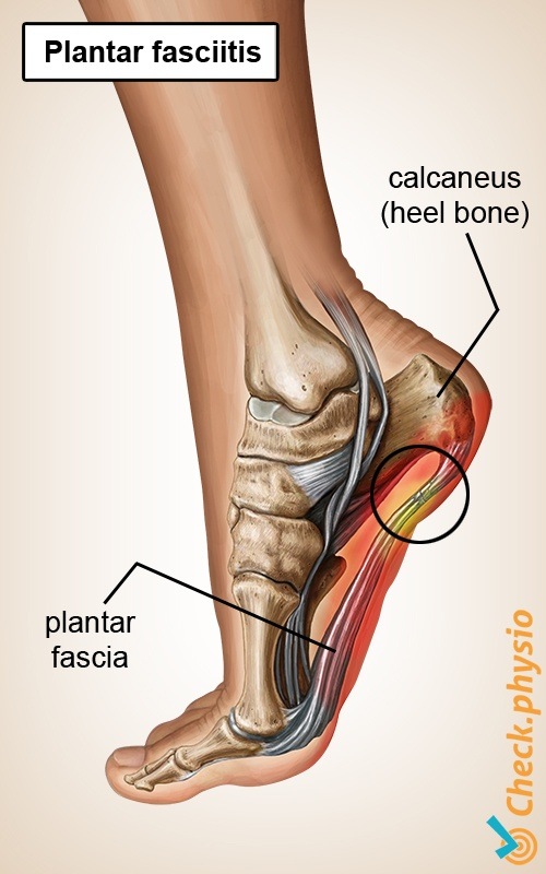 Fuß Plantarfasziitis Aponeurose Fersensporn