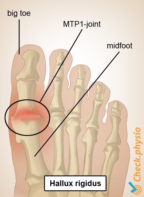 Fuß Hallux rigidus Großzehe MTP 1 Gelenk