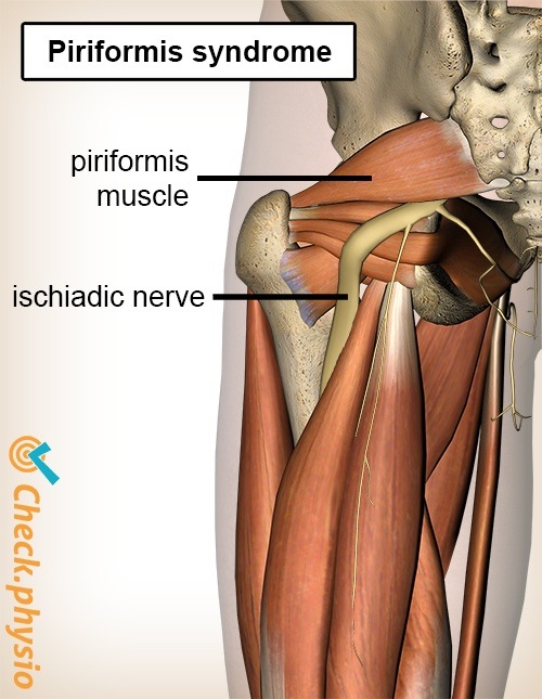 Gesäß Piriformis-Syndrom Anatomie