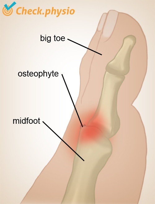 Fuß Hallux rigidus Osteophytenbildung