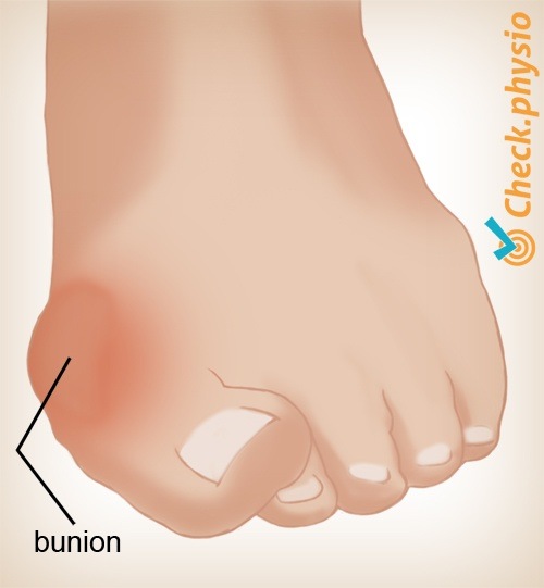 Fuß Hallux valgus Ballenzeh