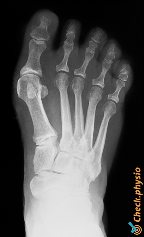 Fuß Hallux valgus Röntgenbild