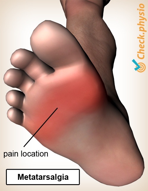 Fuß Metatarsalgie Schmerzstelle