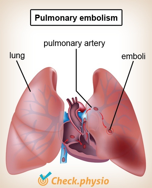 Brust Lungen Lungenembolie Herz Arterie