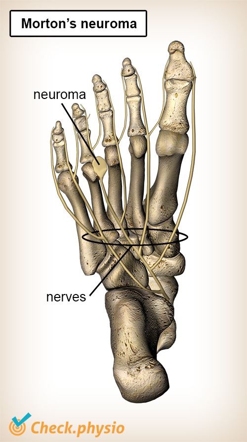 Fuss Mortons Neurom