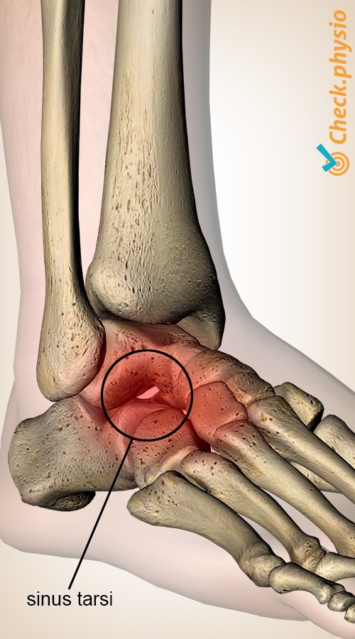 Fuss Sinus-tarsi-Syndrom Talus Calcaneus