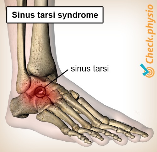 Fuss Sinus-tarsi-Syndrom Tunnel